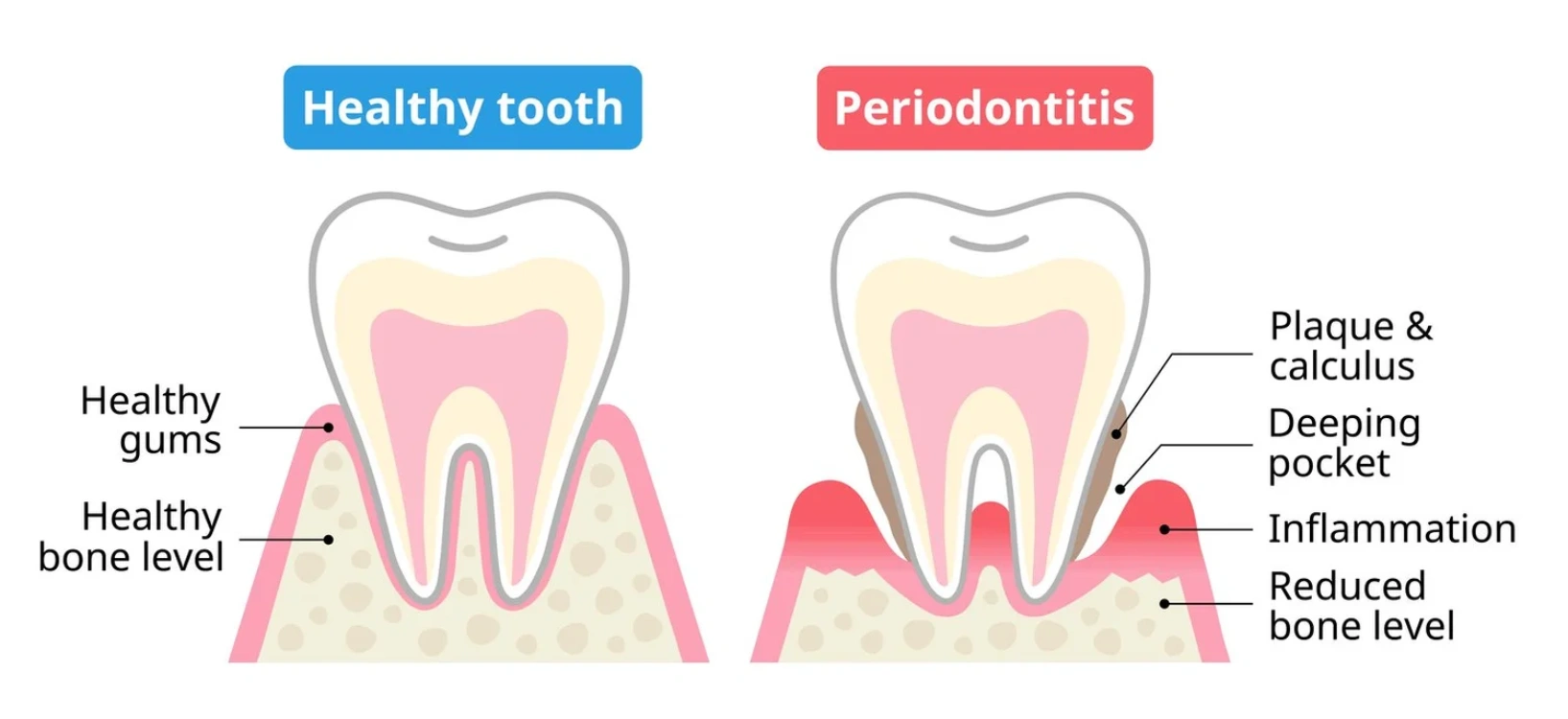 periodontal disease graphic