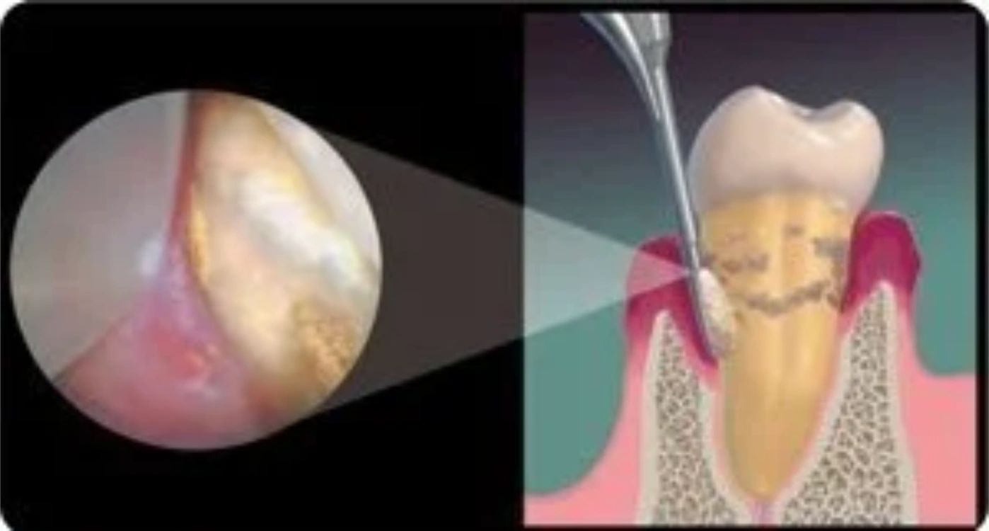 subgingival calculus diagram